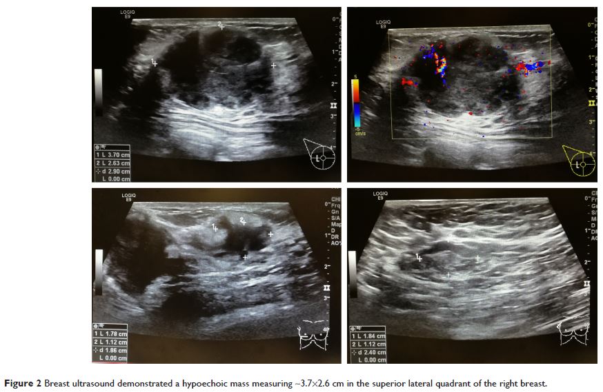 Figure 2 Breast ultrasound demonstrated a hypoechoic mass measuring...
