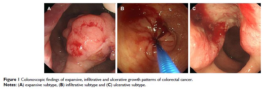 Figure 1 Colonoscopic findings of expansive, infiltrative and ulcerative growth patterns of colorectal cancer.