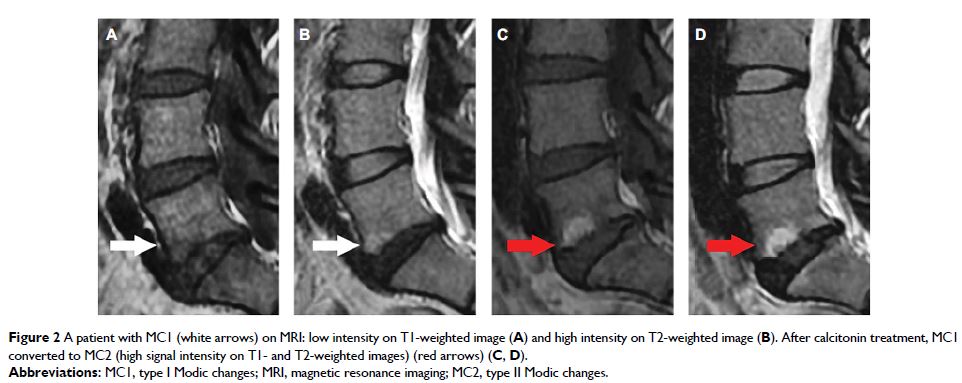 Figure 2 A patient with MC1 (white arrows) on MRI: low intensity on T1-weighted image...