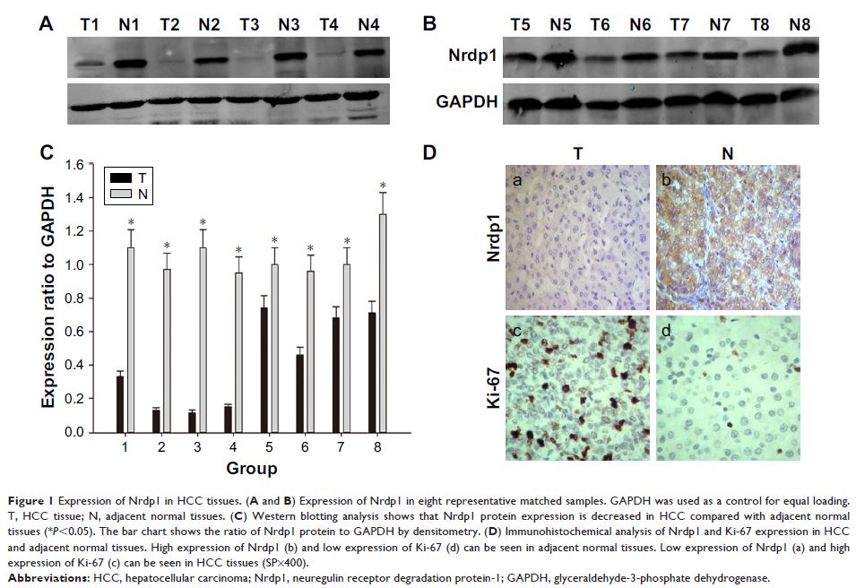 Figure 1 Expression of Nrdp1 in HCC tissues. (A and B) Expression of Nrdp1...