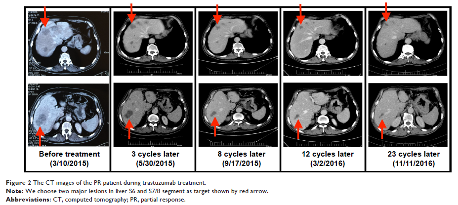 Figure 2 The CT images of the PR patient during trastuzumab treatment.