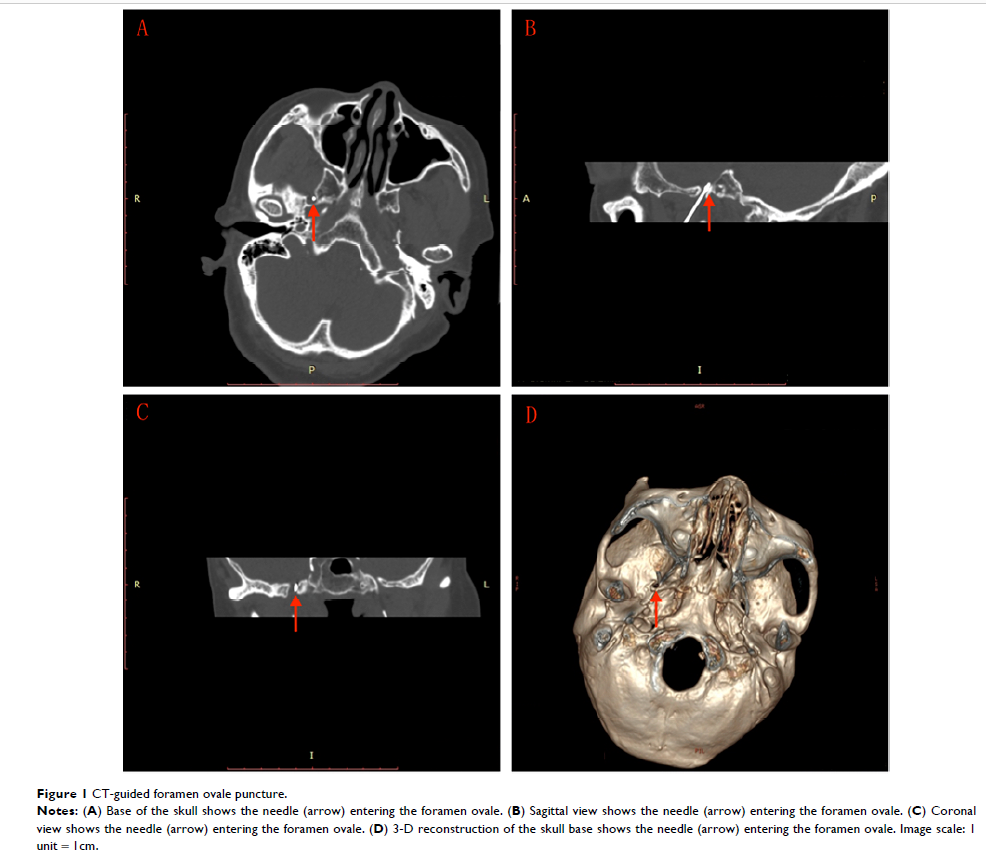 Figure 1 CT-guided foramen ovale puncture.