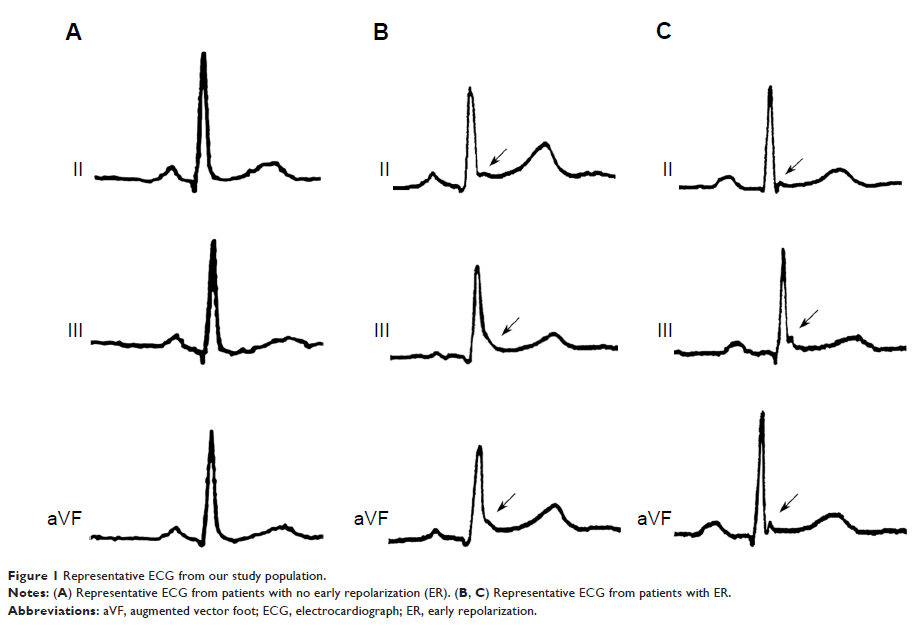 Figure 1 Representative ECG from our study population.
