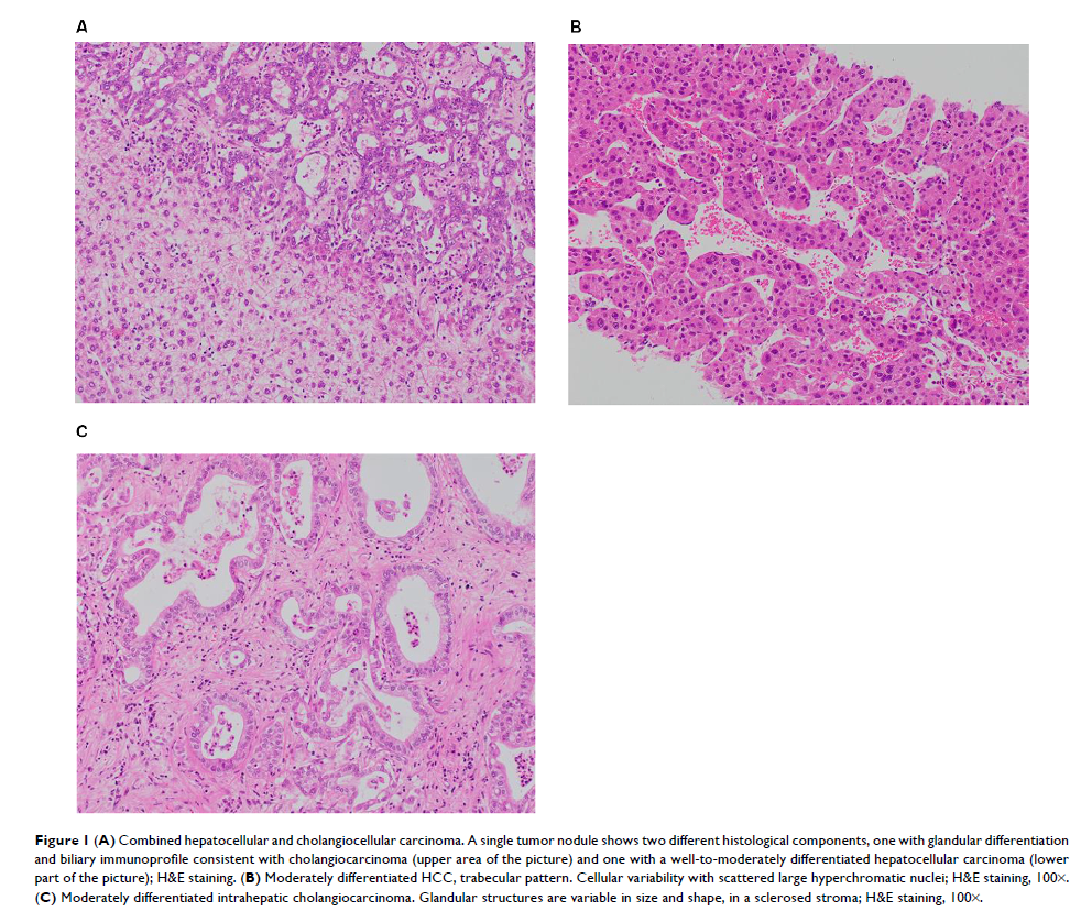 Figure 1 (A) Combined hepatocellular and cholangiocellular carcinoma. A single tumor nodule shows...