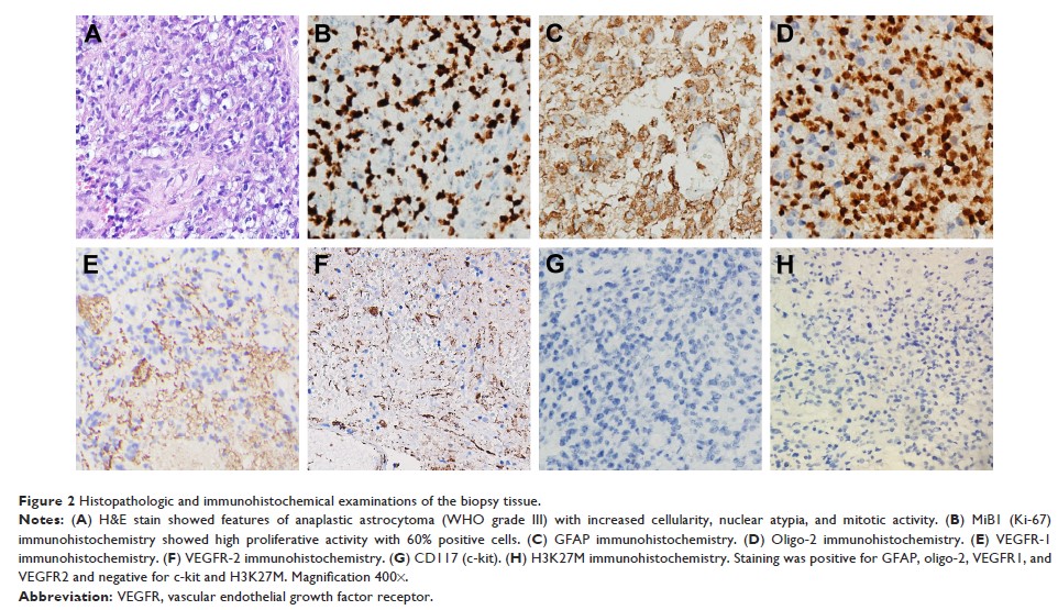 Figure 2 Histopathologic and immunohistochemical examinations of the biopsy tissue.