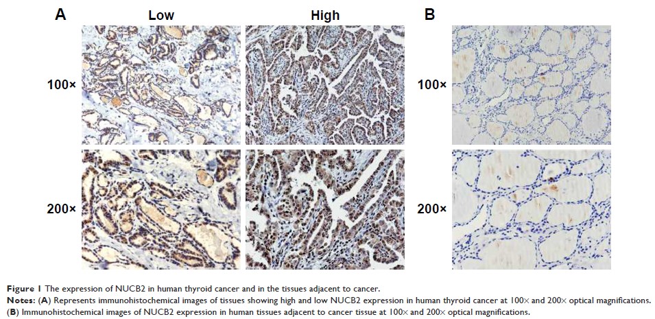 Figure 1 The expression of NUCB2 in human thyroid cancer and in the tissues adjacent to cancer.