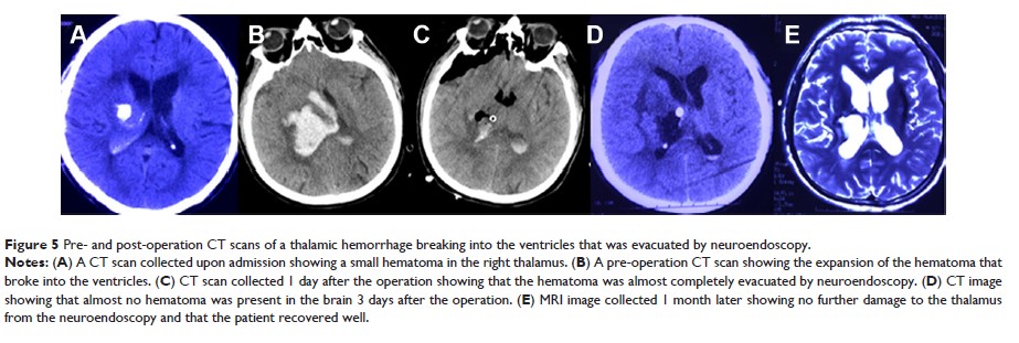 Figure 5 Pre- and post-operation CT scans of a thalamic hemorrhage breaking into...