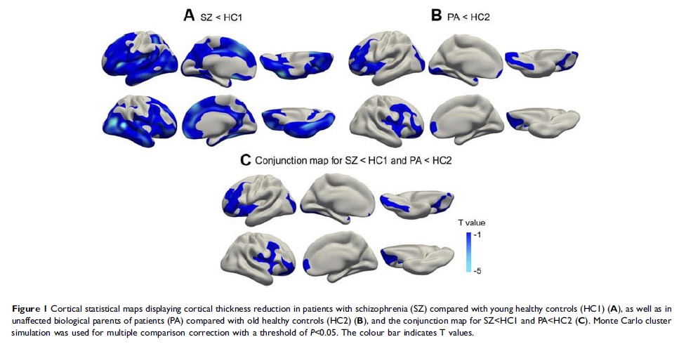 Figure 1 Cortical statistical maps displaying cortical thickness reduction in patients with...
