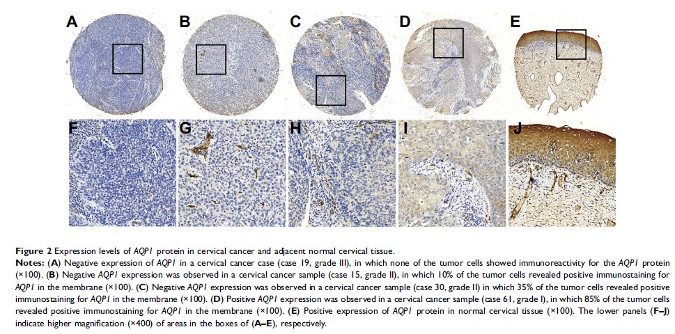 Figure 2 Expression levels of AQP1 protein in cervical cancer and adjacent normal cervical tissue.
