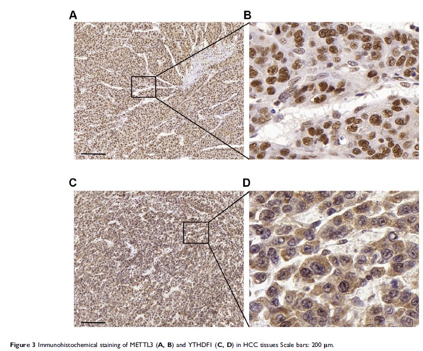 Figure 3 Immunohistochemical staining of METTL3 (A, B) and...