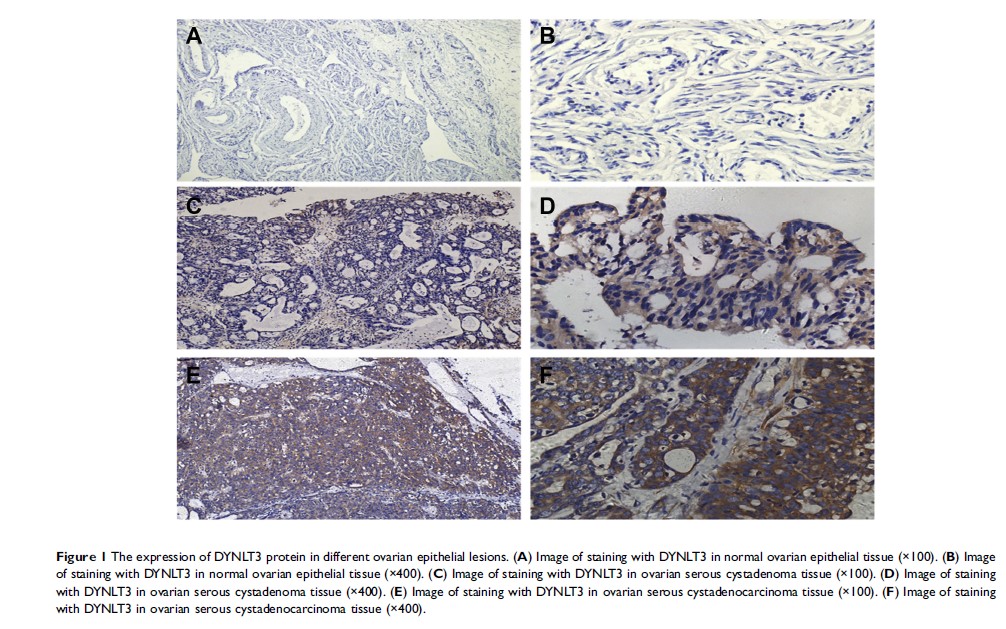 Figure 1 The expression of DYNLT3 protein in different ovarian epithelial lesions...