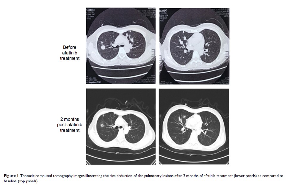 Figure 1 Thoracic computed tomography images illustrating the size reduction of...