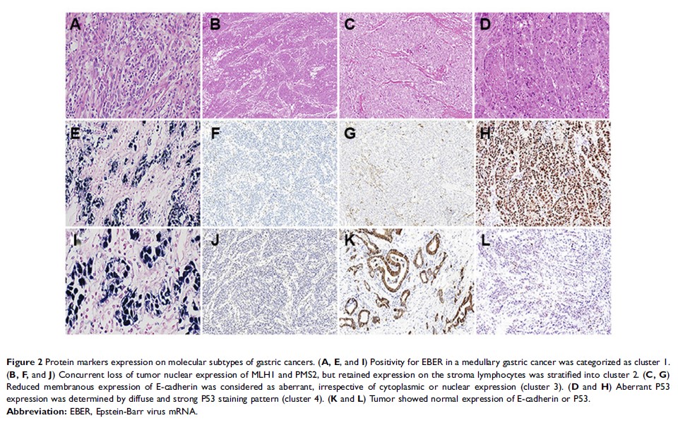 Figure 2 Protein markers expression on molecular subtypes of gastric cancers...