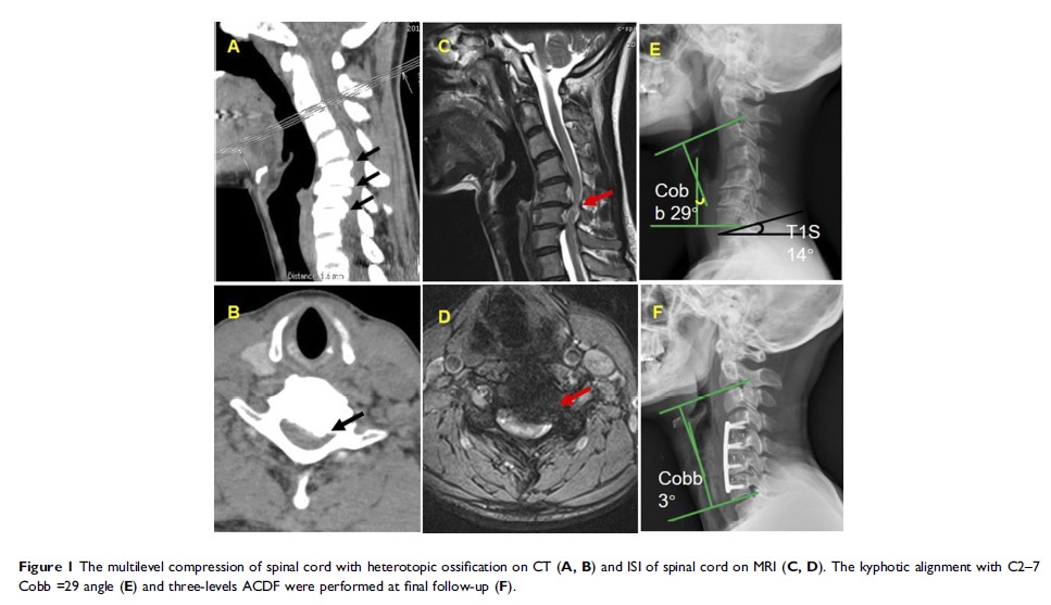 Figure 1 The multilevel compression of spinal cord with heterotopic ossification on CT (A, B) and...