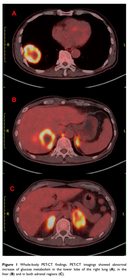 Figure 1 Whole-body PET-CT findings...