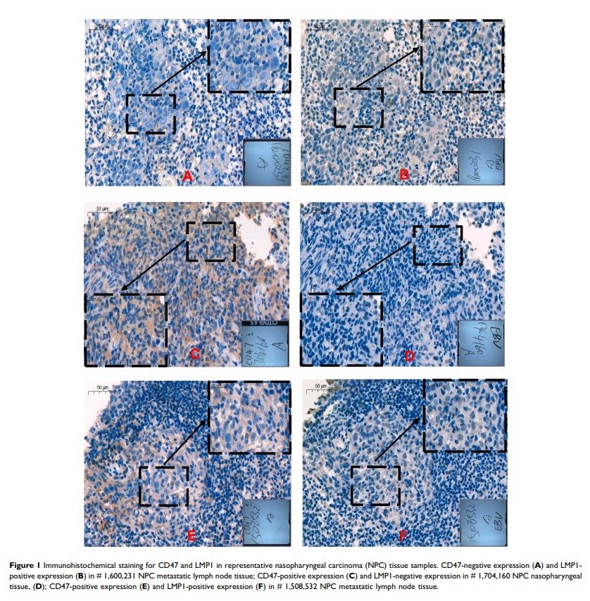 Figure 1 Immunohistochemical staining for CD47 and...