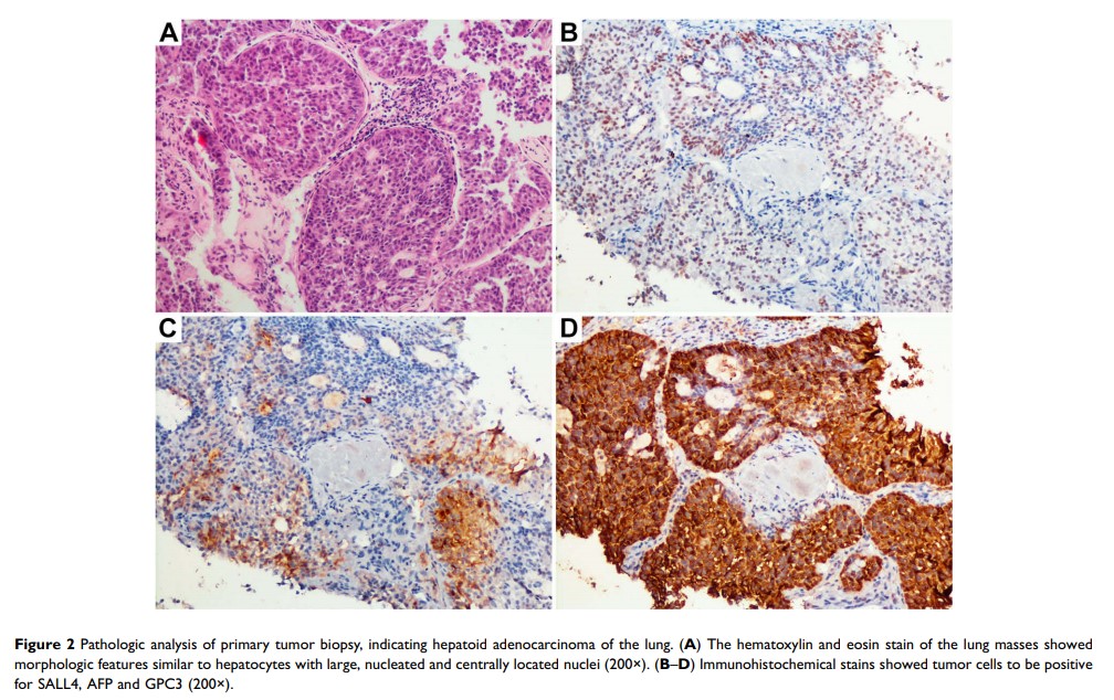 Figure 2 Pathologic analysis of primary tumor biopsy, indicating hepatoid adenocarcinoma of...