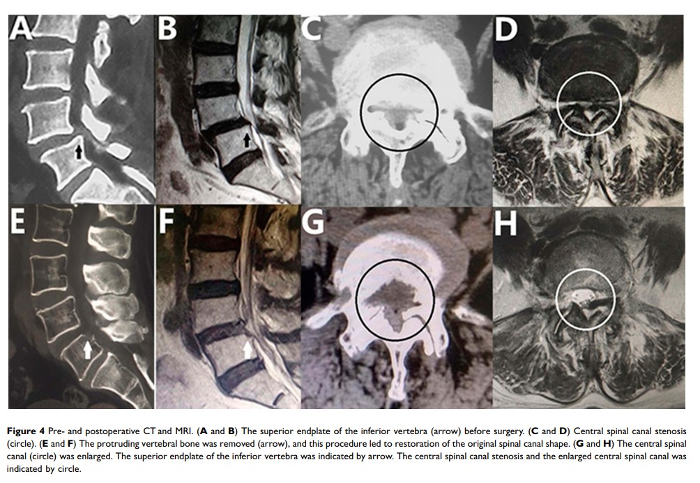 Figure 4 Pre- and postoperative CT and MRI...