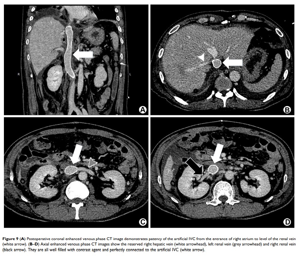 Figure 9 (A) Postoperative coronal enhanced venous phase CT image demonstrates patency of...