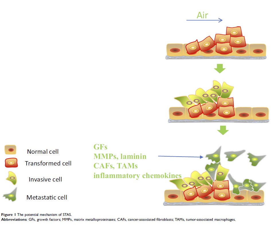 Figure 1 The potential mechanism of STAS. Figure 1 The potential mechanism of STAS.